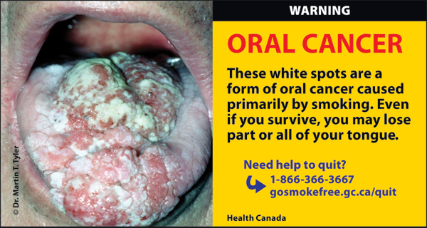 Canada 2012  Health Effects mouth - mouth cancer, gross - eng